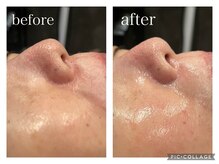 シェリー(Cherie)/剥離なしハーブピーリング