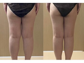 マイティー整骨院 ココア(CoCoa)/活性リンパ洗浄