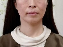 目元 口元のたるみ 眉間シワ改善専門サロン