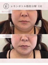 エンルーチェ プラスエイト(en;Luce+8)/レモンボトル脂肪分解　1回