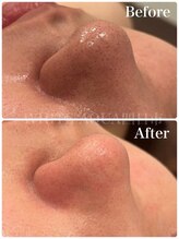 ホワイトアクア 四日市店(WHITE AQUA)/ハイドラ毛穴洗浄/毛穴改善