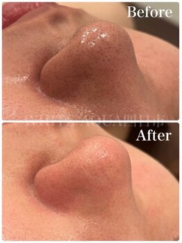 ホワイトアクア 四日市店(WHITE AQUA)/毛穴洗浄/毛穴改善