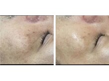 ラエッセ 恵比寿(LAESSE)/毛穴・美白専門店 LAESSE 恵比寿