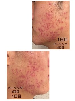 ケーフリー(K-free)/ハーブピーリング