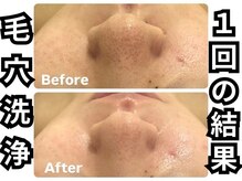 ベル 心斎橋店(Belle)/毛穴洗浄1回の結果