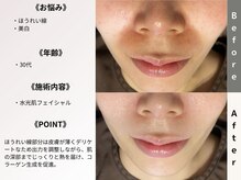 ルディラ 横浜店/水光肌フェイシャル