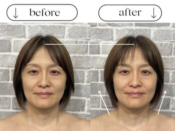 ビースタイル(B-style)/【電気美容鍼】ビフォーアフター