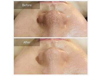 ベンザイ 梅田店(BENZAI)/いちご鼻、毛穴開き、黒ずみ