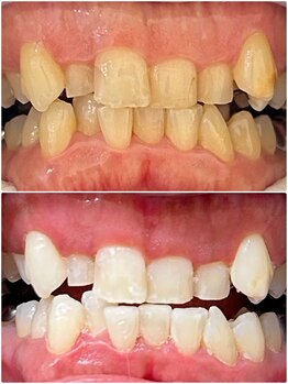 ハモットホワイト(Hamotto White)/照射5日目☆