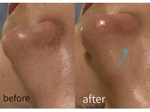 ルーム701(room701)/毛穴　黒ずみ　角栓