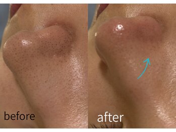 ルーム701(room701)/毛穴 黒ずみ 角栓