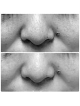 ザ ファーストサロン(The First Salon)/毛穴洗浄　引き締め