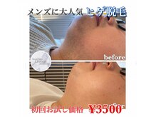リノア 心斎橋店(LINOAH)/メンズに大人気 ヒゲ脱毛