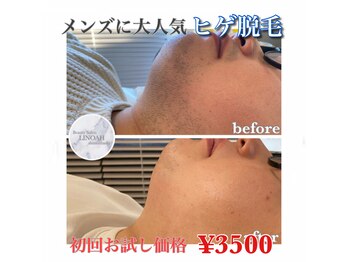 リノア 心斎橋店(LINOAH)/メンズに大人気 ヒゲ脱毛