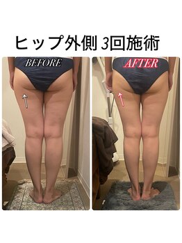 プラス シー(PLUS C)/ヒップ集中☆【3回目】経過
