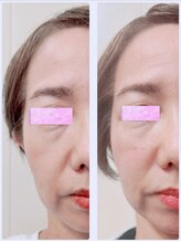 ブロッサム 山内店/NEW☆フェイスリリース効果☆