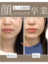 けいのき鍼灸整骨院/20代女性　むくみ小顔