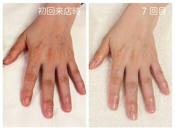 キレイテ 福岡天神店/関節の黒ずみとくすみ