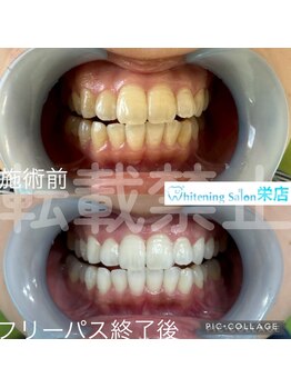 ホワイトニングサロン 名古屋 栄店/【ホワイトニング】