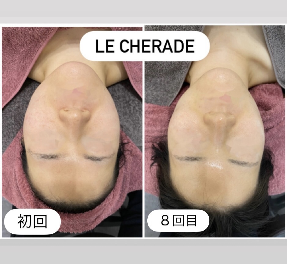 リシェラード/赤み、ニキビケア、毛穴ケアも♪