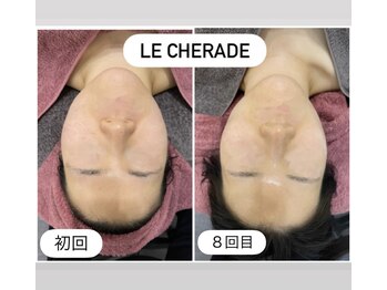 リシェラード/赤み、ニキビケア、毛穴ケアも♪