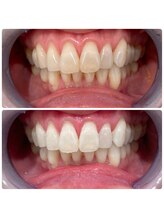 エクシアホワイトニング 日本橋店/挙式ホワイトニング