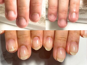 深爪だった自分の爪、忘れました