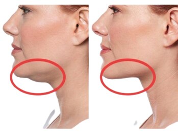 サボラミ(sabor A Mi)の写真/驚きの針を使わない脂肪分解！DTほぼ無しで、スッキリ小顔と左右差、口横ポニョのお悩みを解消★