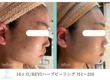 フローレ 豊田店(Flore)/改善が難しいニキビケアもお任せ