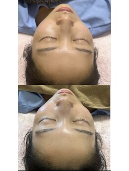 マホロバ(mahoroba)/ララピール×美容鍼(マホロバ)