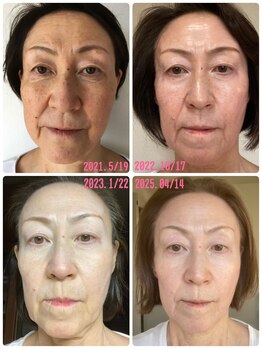 ルルーディア(LOULOUDIA)/母の症例写真です。