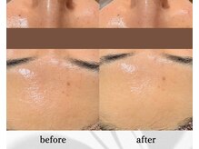 アン ビューティー(ann beauty)/施術1回【症例写真】30代女性