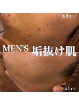 ジェノール 2nd beauty studio 姫路駅前店(JNOEL)/メンズも垢抜け！肌質改善