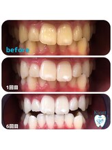 キラット 高知店(Kiratt)/ホワイトニングが初めてのお客様