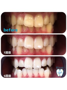キラット 高知店(Kiratt)/ホワイトニングが初めてのお客様