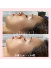 ウル(Ulu)/二重あご解消