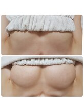 美人バスト リグラス(ReGrous)/バストアップbefore,after