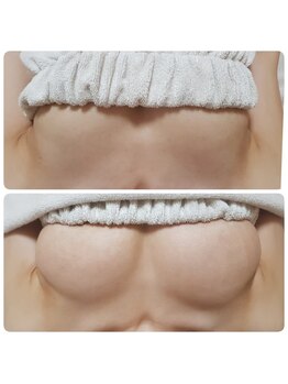 美人バスト リグラス(ReGrous)/バストアップbefore,after