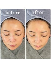 サロンピュア 所沢店/光フェイシャルモニター様♪