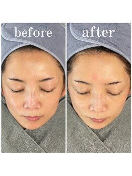 サロンピュア 所沢店/光フェイシャルモニター様♪