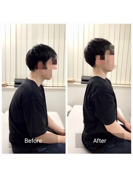 ナオル整体 新宿院(NAORU整体)/20代男性-姿勢矯正1ヶ月経過