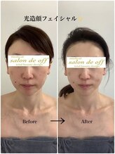 メディカルサロンドオフ 堺東店(medical salon de off)/光造顔フェイシャル★　施術前後