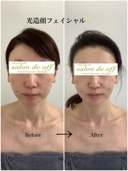メディカルサロンドオフ 堺東店(medical salon de off)/光造顔フェイシャル★　施術前後