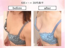 リール 恵比寿店(RIRE)/バストアップ症例【広尾恵比寿】