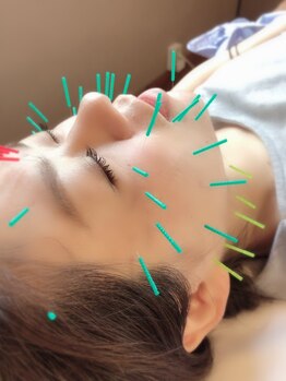 すみれ鍼灸整骨院/整体院の写真/【限定クーポン有】速攻実感!むくみ・リフトアップ・たるみ・くすみ・肌荒れ解消★自信の持てる横顔へ*