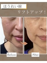 けいのき鍼灸整骨院/50代女性　ほうれい線たるみ　