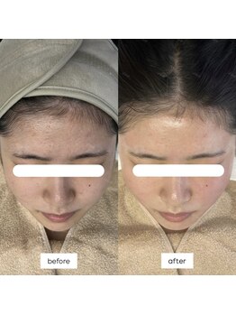 ブレデサガ(B’lady Saga)/ワックス脱毛でも美肌作り☆