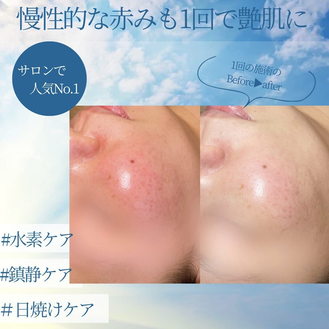 人気NO.2 艶肌水光肌スペシャルデトックスコース￥33,000→￥5500