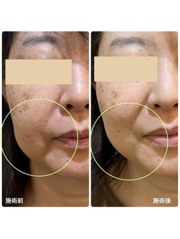 チョチョワンプラス(緒々one+)/口横のぽにょ改善◎