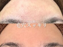 ルアナアイナ 大分/ハーブピーリング(6)